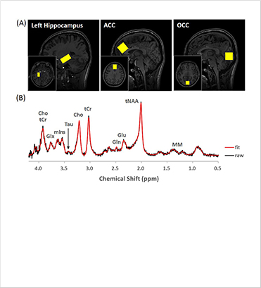 [Figure 1] (A) Brain regions where spectra were measured (yellow box) (B) <sup>1</sup>H MR spectrum in the hippocampus.