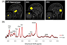 Identification of decreased taurine concentration in the hippocampus of young depressed women at 7T human MRI