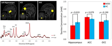 주요 우울장애 여성 해마의 타우린 농도차이
